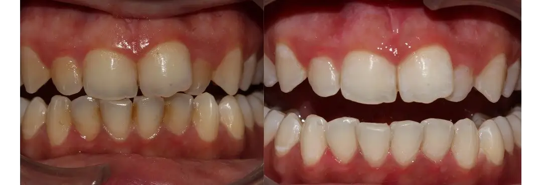 teeth cleaning before and after results of patient 